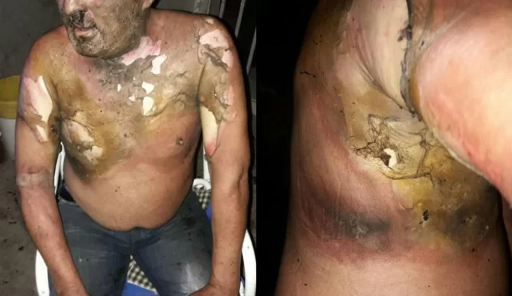 Falleció el hombre que sufrió graves quemaduras en un accidente doméstico